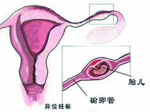 宫外孕和早孕症状,你能分清吗