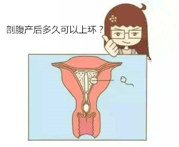 剖腹产后多久可以上环?产后妈妈要注意的这些事!
