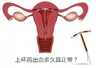 上环后出血多久算正常?出血时间长该怎么处理?