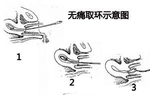 【取环全过程大曝光!】_取环手术要多长时间?