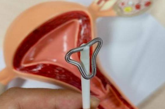 淮安一般取环需要多少钱?【提问】取环后的好处和变化?